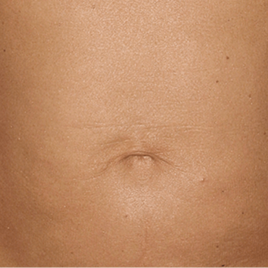Thermage Tummy - After
