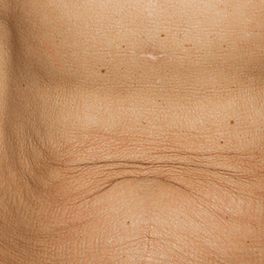 Thermage Tummy - Before